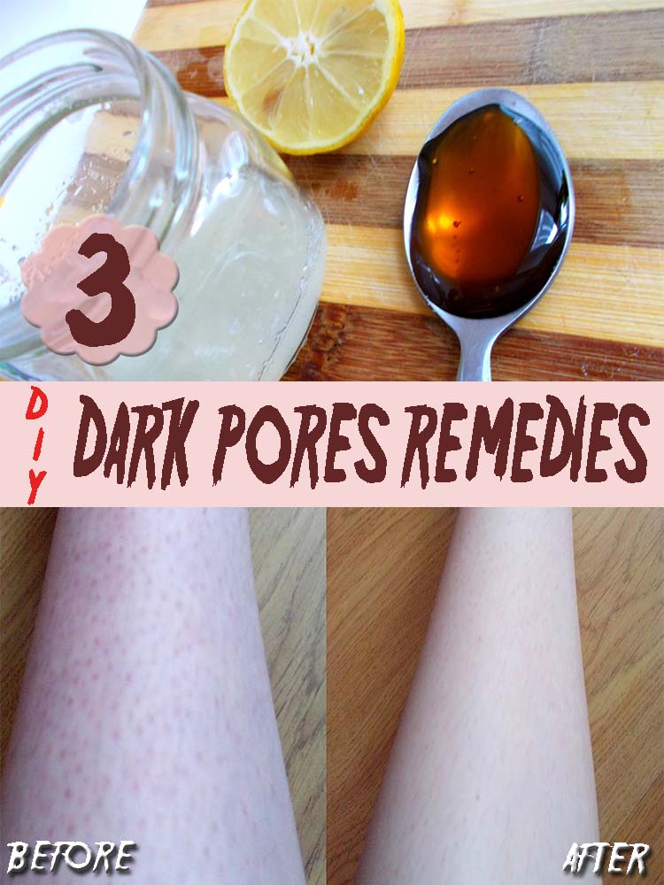 3 Homemade Remedies for Dark Pores2