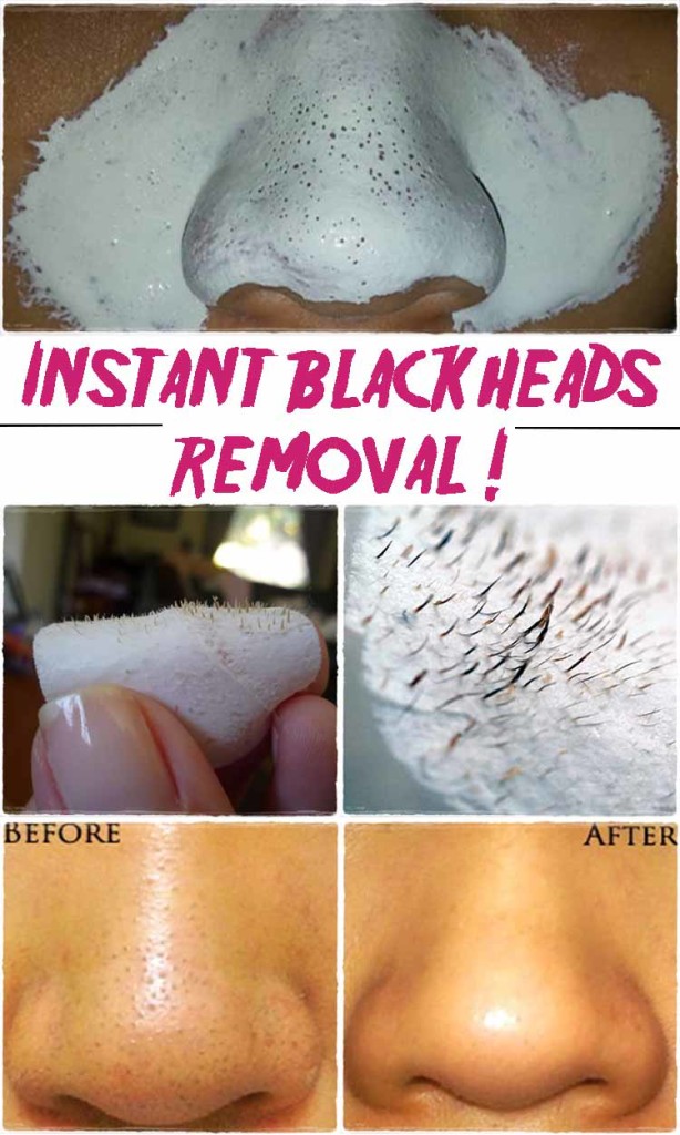 Say Goodbye Blackheads In 15 Minutes Homemadelifeproject 