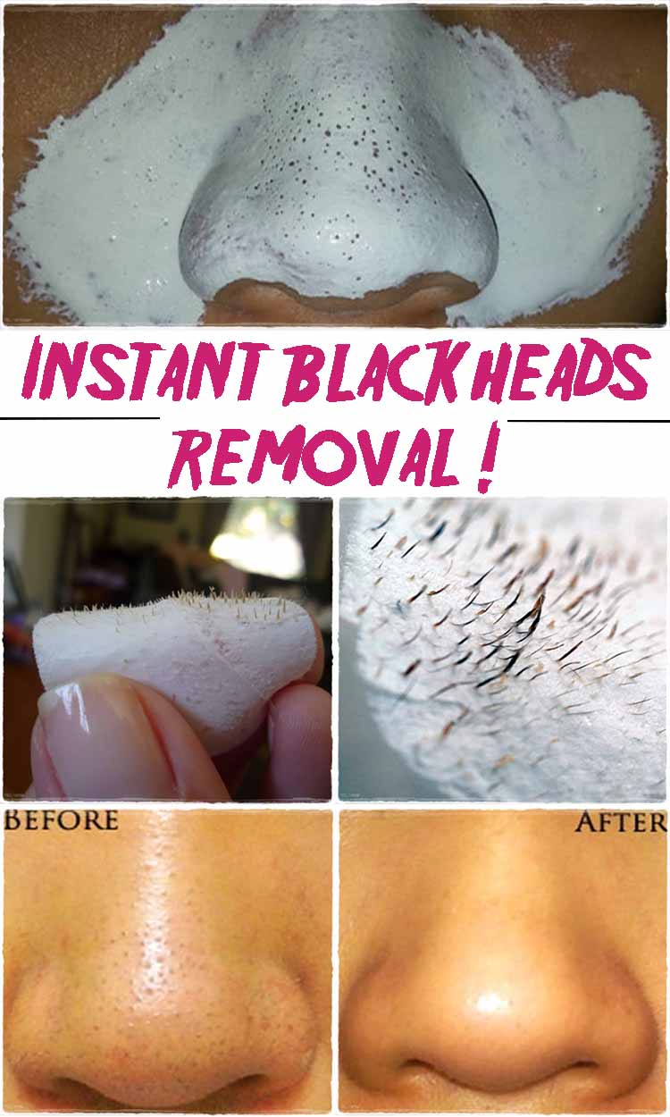 Say goodbye blackheads in 15 minutes !