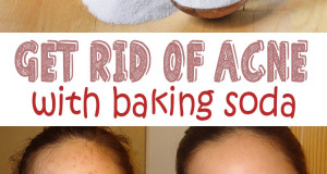 Get rid of acne using baking soda